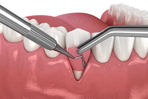 Gum Augmentation Surgery