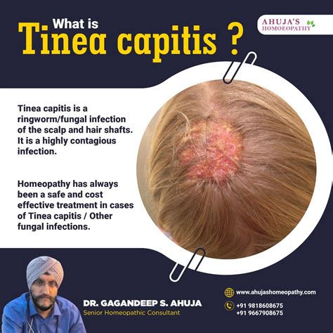 Treatment For Tinea Capitis