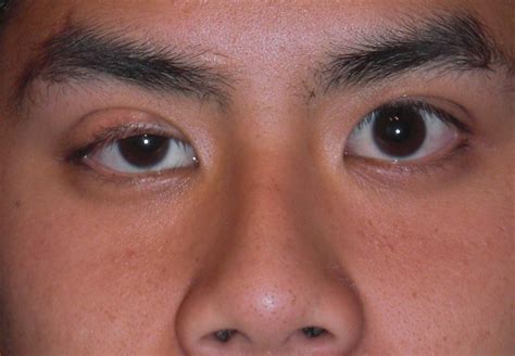 Causes and Treatments of Styes and Eyelid Bumps