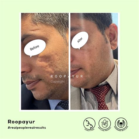 Best Acne Scar Healing Combo – Reduce Acne Pits, Dark Spots, & Shrink