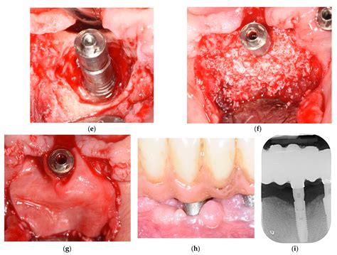 Absence of Progressive Bone Loss Following Peri-Implantitis Surgical ...