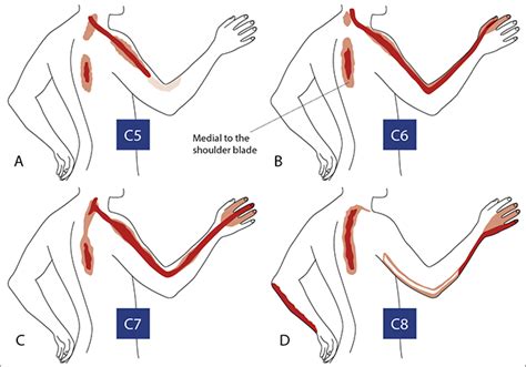 Kuvatulokset haulle cervical radiculopathy