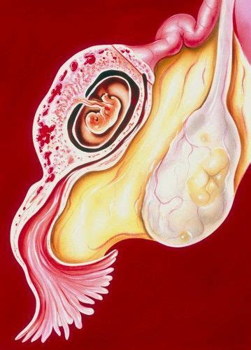 quotes about ectopic pregnancy