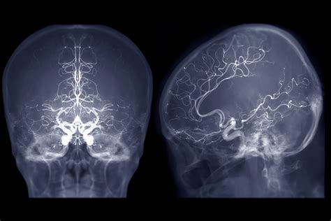 Image result for Fluoroscopy without Contrast