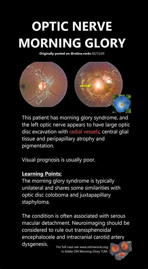 Optic Nerve Disorders > Morning Glory Syndrome - Retina Rocks