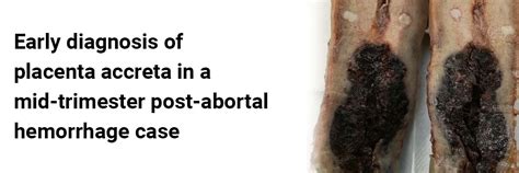 Early diagnosis of placenta accreta in a mid-trimester post-abortal ...