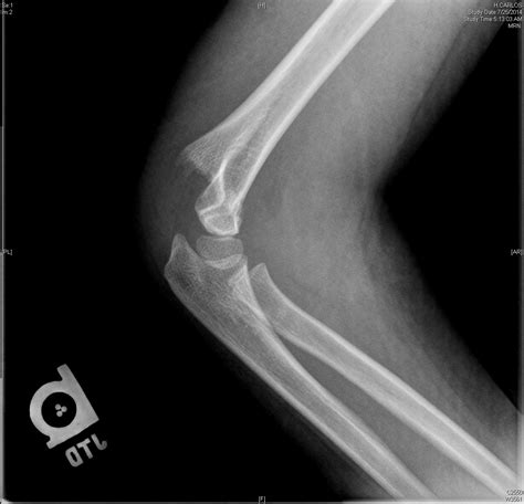 Supracondylar Humerus Fracture