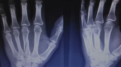 Xray Broken Hand