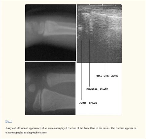Buckle (Greenstick) Fracture of the Distal Radius - Sports Medicine Review