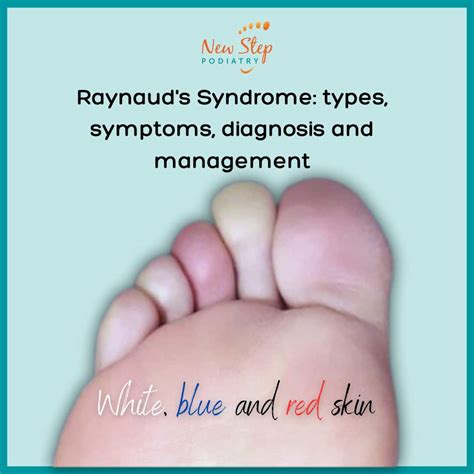 Raynauds Syndrome Foot Raynaud's Disease Harvard Health