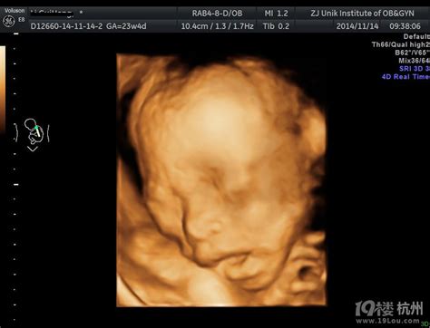 35周胎儿早产严重吗（浅谈早产带来的几个危害） - 主妇去哪儿