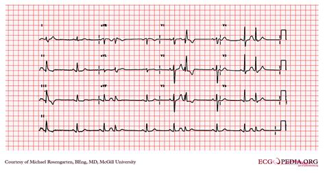 Premature atrial contraction electrocardiogram - wikidoc