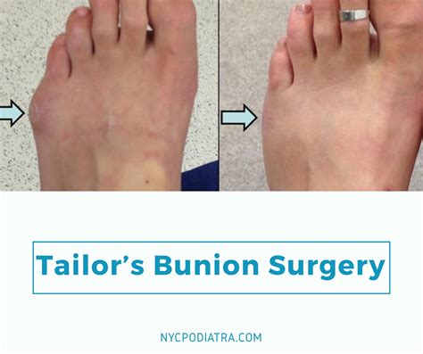 Treating Tailor's Bunion