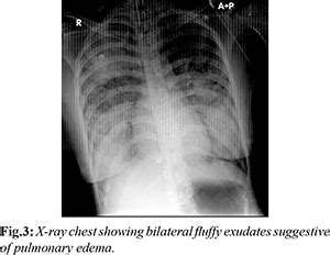 Neurogenic Pulmonary Edema : A Rare Presentation of Traumatic Brain Injury