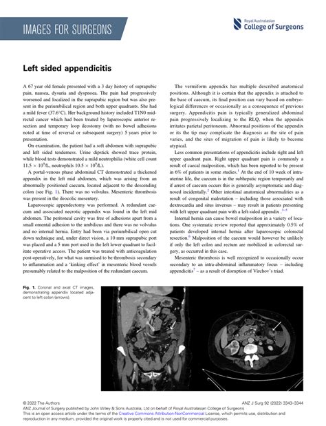 Image result for Appendicitis Left Side