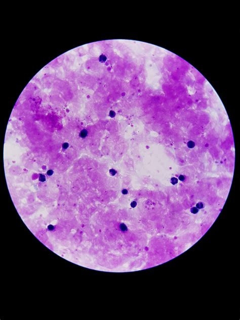 Malaria Thick Blood Smears | IEEE DataPort