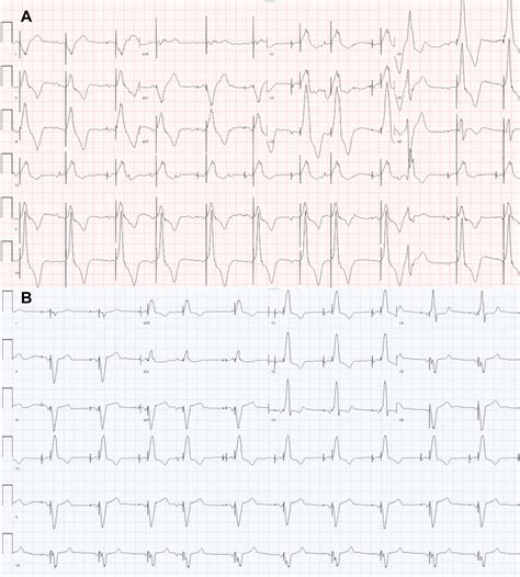 Loss of right ventricular capture: When it is not the lead’s fault ...