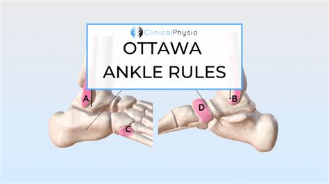 Ottawa Criteria Ankle