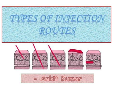 Injection Types 的图像结果