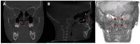 Association between Rapid Maxillary Expansion and Nocturnal Enuresis in ...