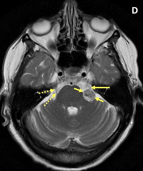 Vestibular Schwannoma - MRI Online / Medality