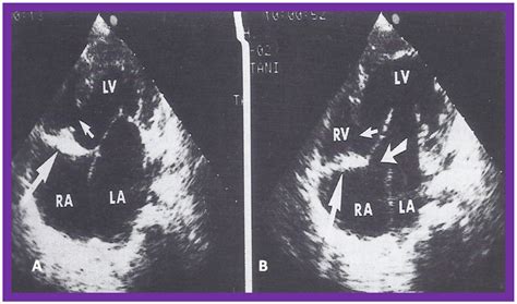 Echocardiography in the Diagnosis and Management of Tricuspid Atresia