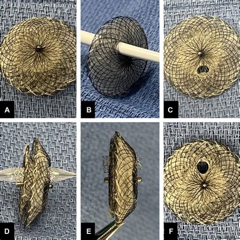 Use of Flow Restrictors in Congenital Heart Disease - Interventional Cardiology Clinics