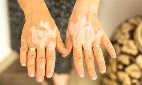 Phototherapy with topical antioxidants, corticosteroids, or calcineurin ...