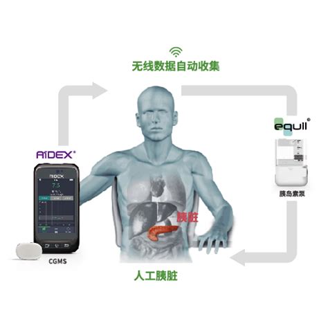 人工胰脏-微泰医疗器械（杭州）股份有限公司