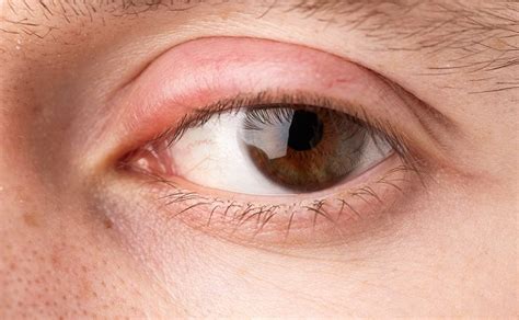 Bildergebnis für augenlidentzündung bilder