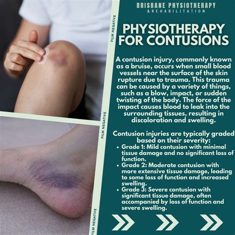 Physiotherapy Management of Contusions - Brisbane Physiotherapy & Podiatry