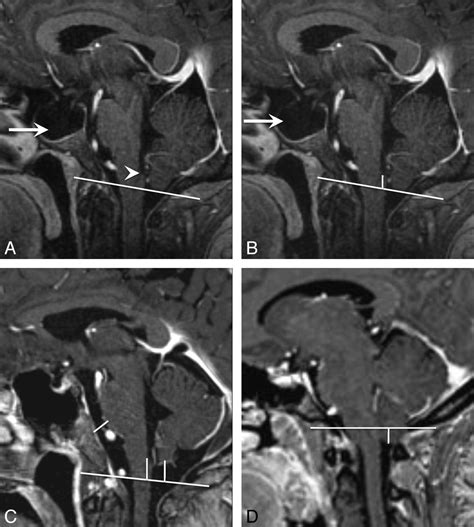 Normal Cerebellar Tonsils