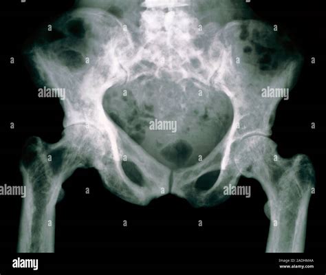 Pagets Disease Xray Appearance at Roscoe Johnson blog