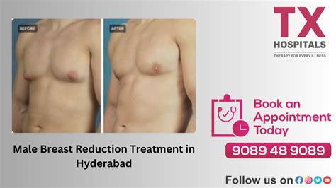 Choosing the Right Hospital for Male Breast Reduction in Hyderabad