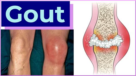 Gout In Knee