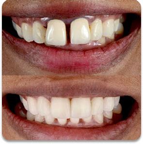 Braces for crooked teeth : The types, process & benefits