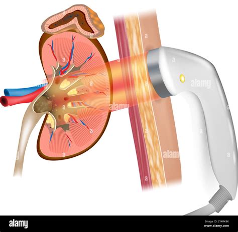 Extracorporeal shock wave lithotripsy or ESWL. Treatment kidney stones Stock Vector Image & Art ...