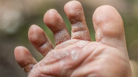 Fungal Infection: बरसात की वजह से पैरों में हो गया है फंगल इंफेक्शन, तो ...