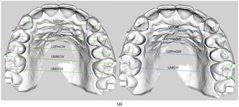The Predictability of Transverse Changes in Patients Treated with Clear ...