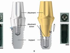 Image result for abutment