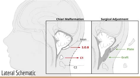 Chiari Malformation Surgery