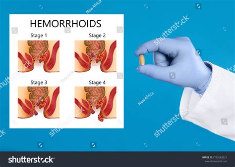 Stage 1 Hemorrhoids