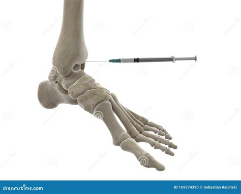 Image result for Ankle Injection Procedure