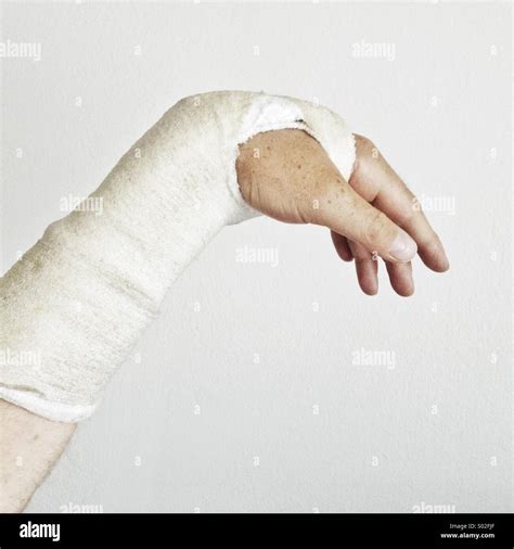 Broken wrist with a plaster cast Stock Photo: 309842807 - Alamy