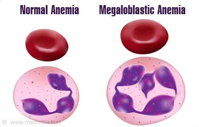 MEGALOBLASTIC ANEMIA – Dentowesome