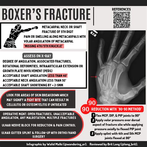 Treatment For Boxer's Fracture