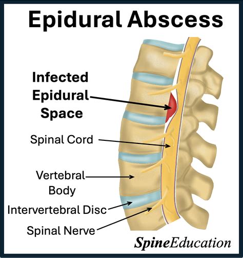 Epidural Abscess - Spine Education