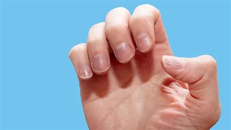 Vitamin Deficiency Disease Symptoms Weak Hair Nails Ulcer Night ...