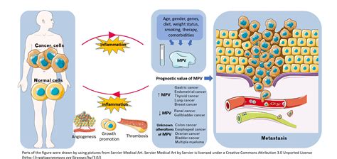 Relation of Mean Platelet Volume (MPV) with Cancer: A Systematic Review ...