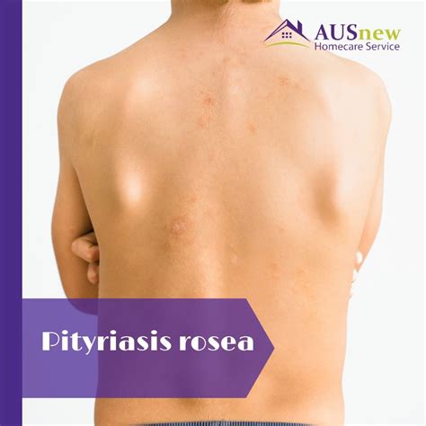 Emollients For Pityriasis Rosea